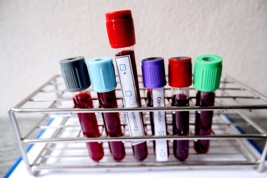 Profesyonel doktorlar, koroner virüs enfeksiyonları analizi ve bulaşıcı hastalıklar, tıbbi kavramlar ve sağlık hizmetleri örneklerinin teşhisi için kan testlerinden COVID-19 testleri gerçekleştirirler..