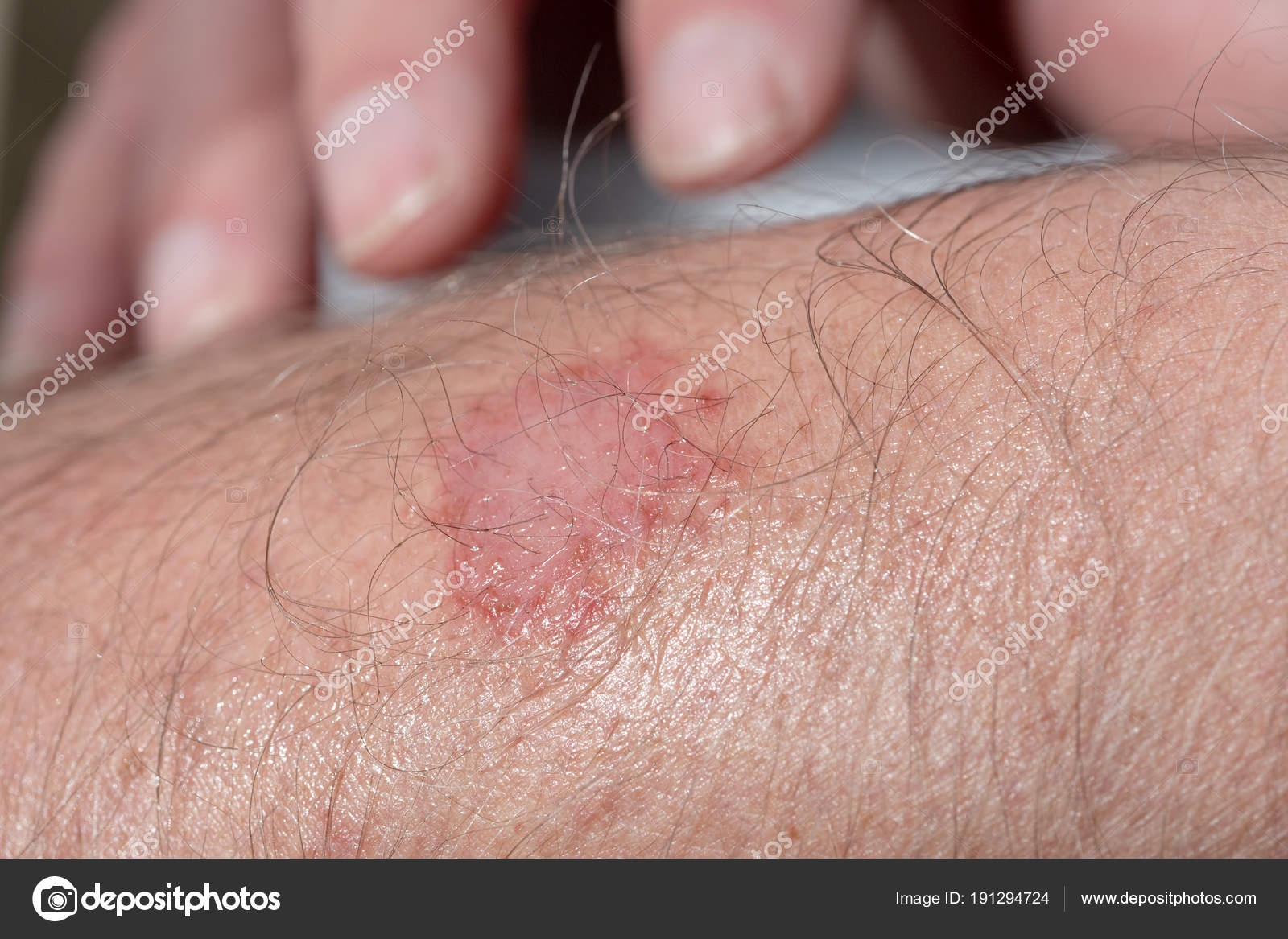 eczema sur le bras eczema sur le bras
