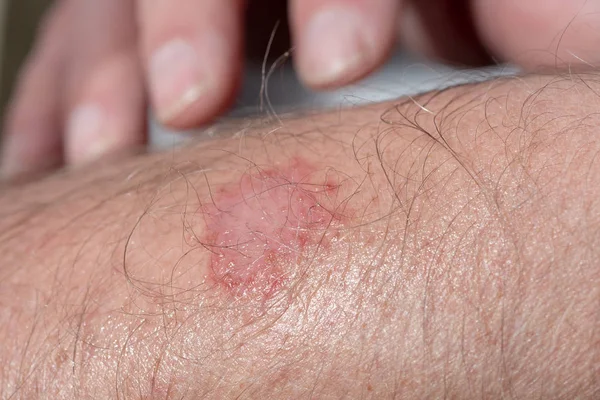 Eczema no braço de um homem — Fotografia de Stock