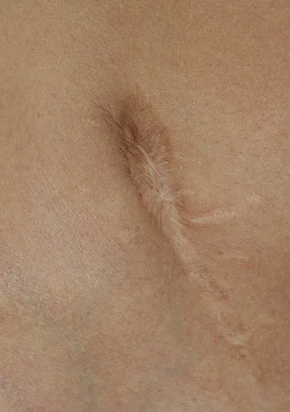 Small scar after appendicitis surgery. Fragment of the body of a man with a scar.