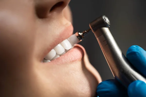 Processo de utilização de escova dentária como uma etapa do procedimento de limpeza dental profissional em close-up clínica, conceito de saúde — Fotografia de Stock