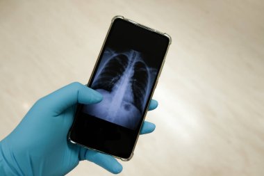 Doktor, hastanın göğüs röntgenini akıllı telefondan kontrol et.
