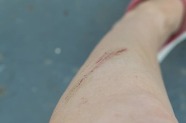 İnsan vücudunu çürüklerle yakından çek. 