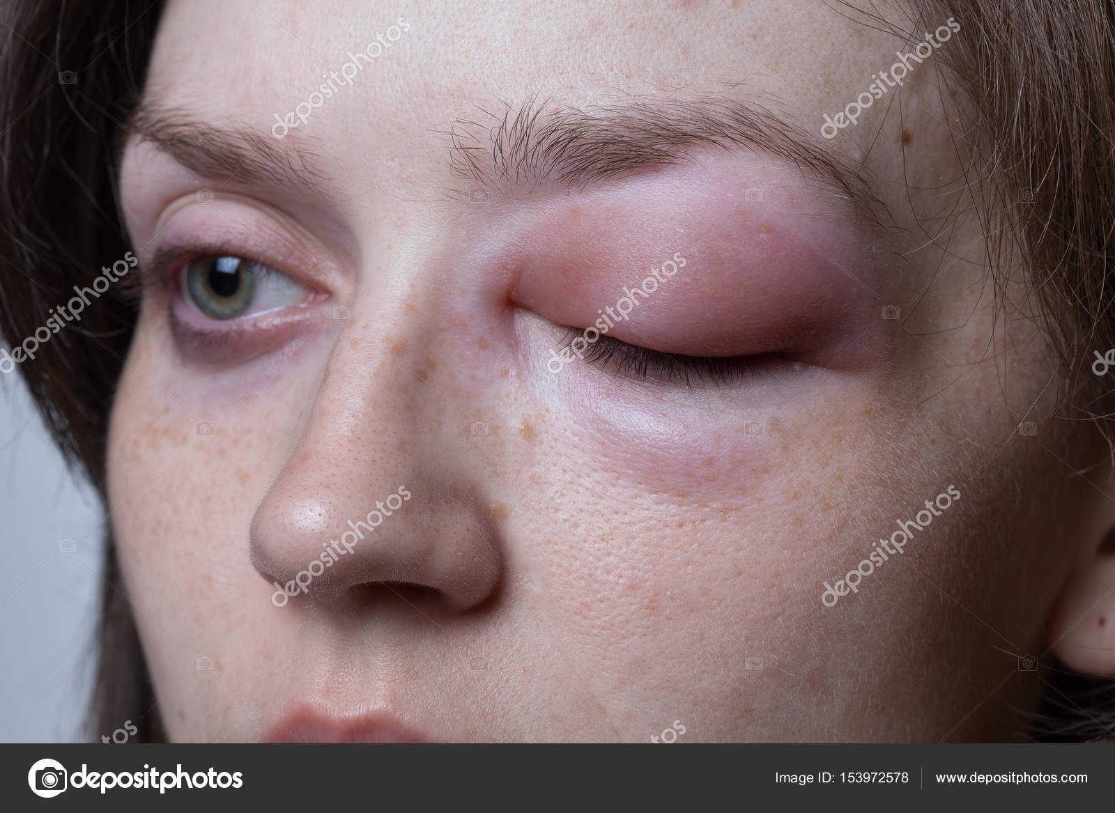 Junge Frau mit der allergischen Reaktion Angioödem — Stockfoto