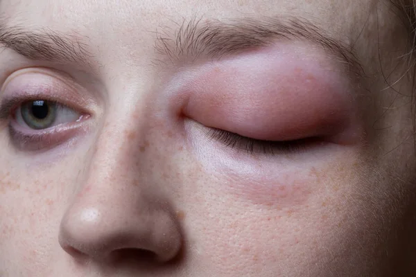 Mulher jovem com reação alérgica — Fotografia de Stock