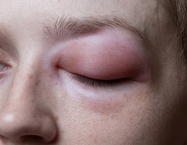 Mulher jovem com reação alérgica no olho — Fotografia de Stock