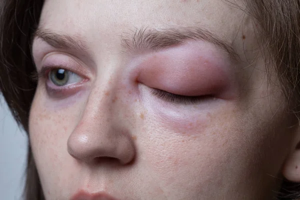 Mulher jovem com reação alérgica angioedema — Fotografia de Stock