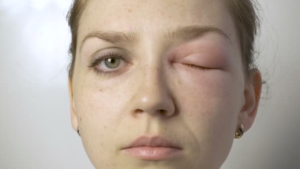 Young woman with allergy on eye — Stock Video