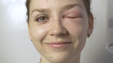 Gülümseyen genç kadın alerjisi gözde