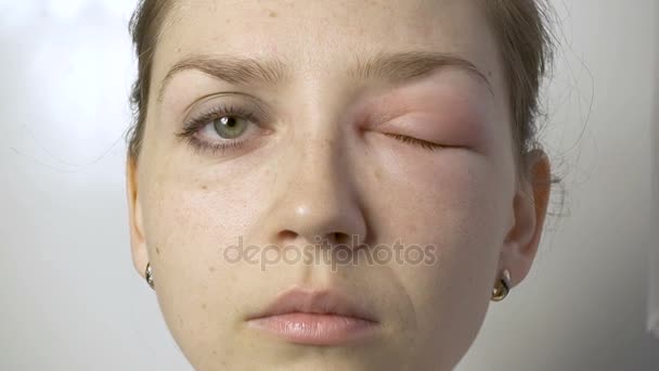 Woman with allergy looking up, down, left, right — Stock Video