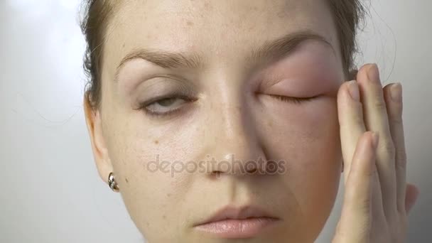 Mujer joven con alergia tratando de abrir los ojos — Vídeo de stock