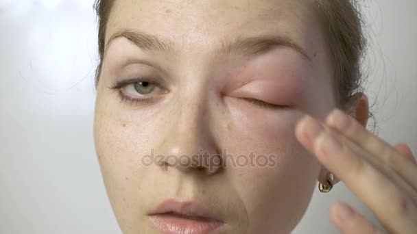 Молодая женщина с аллергией трогательный глаз — стоковое видео