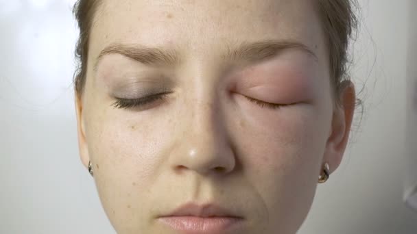 Jovem mulher sorridente com alergia no olho — Vídeo de Stock