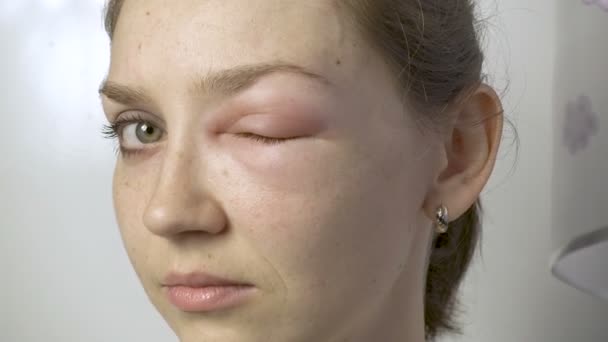 Vrouw met allergie aanraken van ogen — Stockvideo