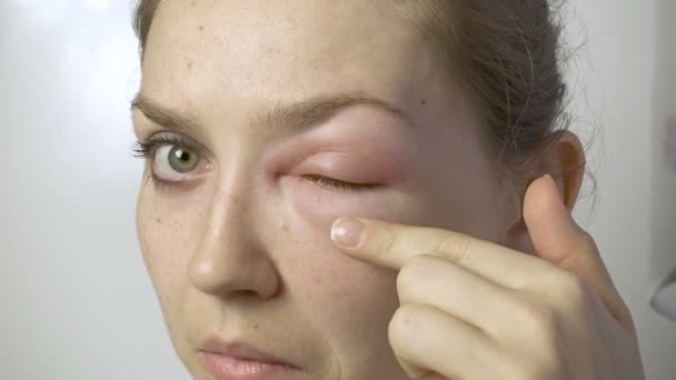 Junge Frau mit allergischer Reaktion berührt Auge — Stockvideo