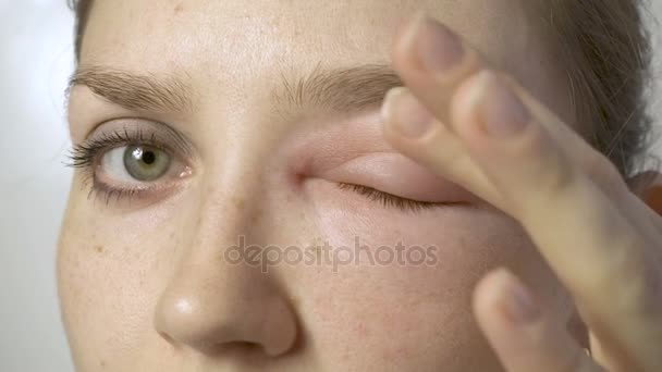 Kvinna med allergisk reaktion att röra ögat — Stockvideo