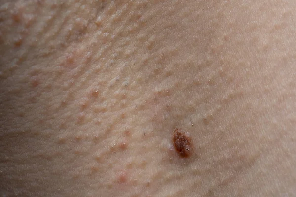 Foto di texture della pelle umana con nevo, macro ripresa — Foto Stock