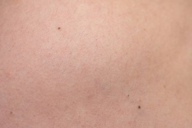Nevus 'lu kadın derisinin dokusu, yakın plan fotoğrafı.