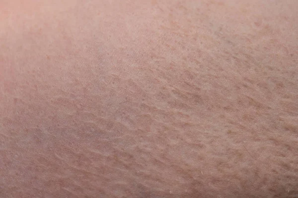 Textura de la piel humana con la cicatriz quemada —  Fotos de Stock