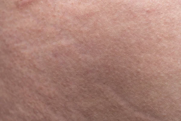 Texture of humans skin with the stretch marks, closeup photo — ストック写真