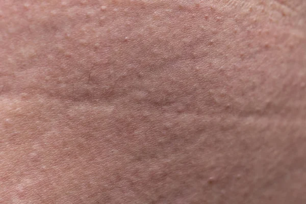 Pattern of humans skin with the stretch marks, closeup photo — Stock Photo, Image