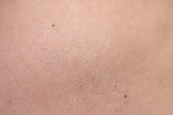 Textur av kvinnor hud med nevus, närbild — Stockfoto