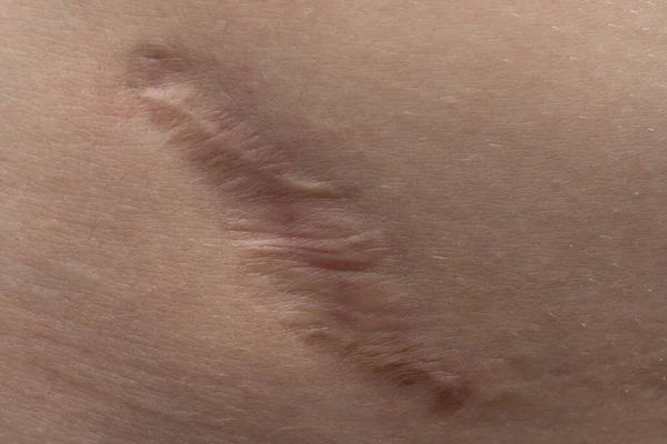 Macro foto de la cicatriz del joven humano textura — Foto de Stock