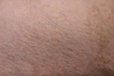 Yara izi olan erkek derisi, yakın çekim fotoğrafı.