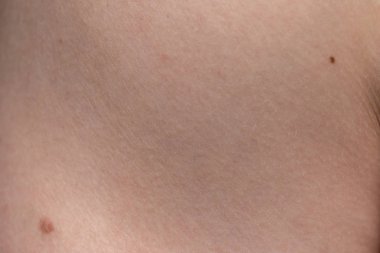 Nevus ile insan derisinin dokusu, yakın çekim fotoğrafı.