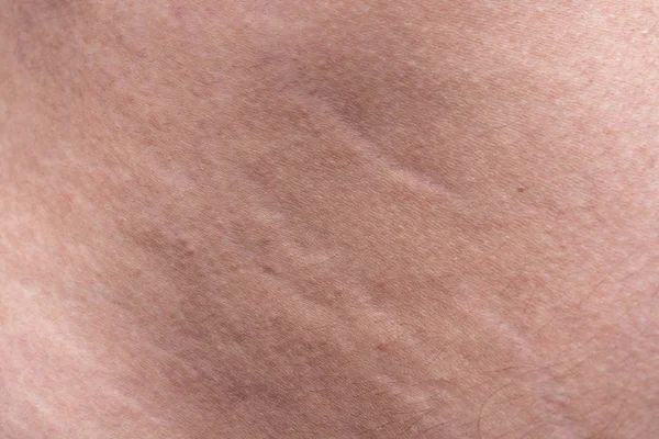 Texture di derma umano con le smagliature, foto in primo piano — Foto Stock