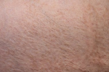 Yara izi olan erkek derisi fotoğrafı, yakın çekim fotoğrafı.