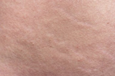 Genişleme izleri olan erkek derisinin dokusu, yakın çekim fotoğrafı.