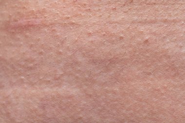 Pembe insan derisinin dokusu, gerilme izleri, yakın çekim fotoğrafı.
