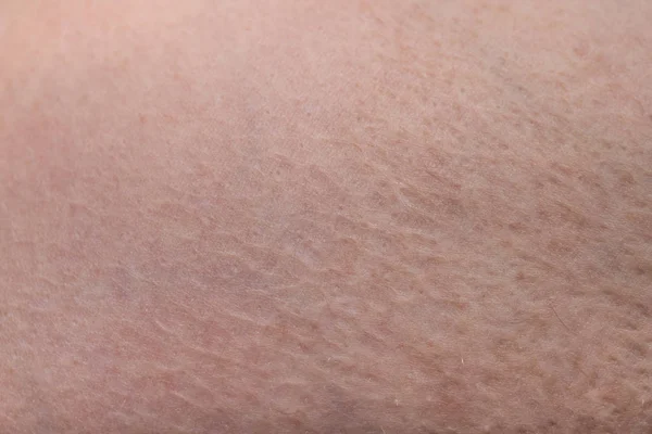 Textur av mänsklig hud med ärr bränna, närbild foto — Stockfoto