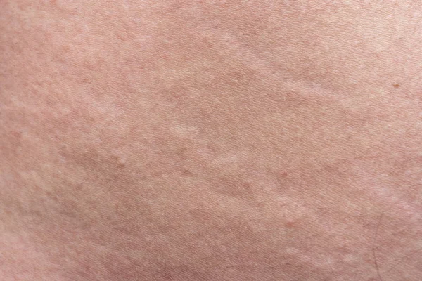 Texture of mans skin with the stretch marks, closeup photo — Stock Photo, Image