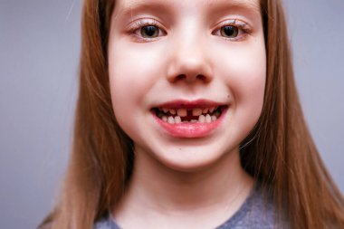 Alt süt dişleri dökülen bir kızın yakın plan yüzü.