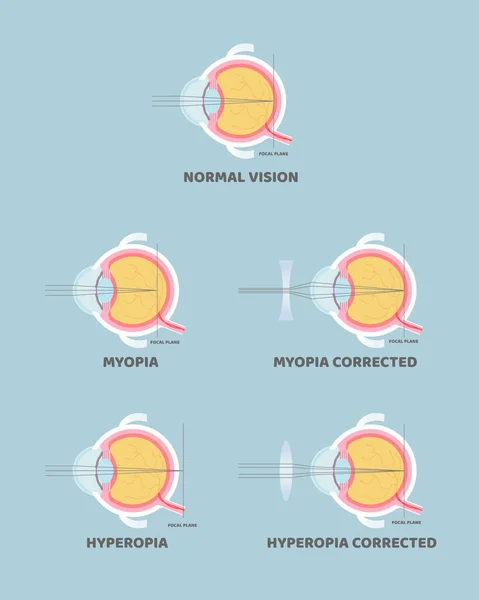 Anatomia Globo Ocular Órgãos Internos Parte Corpo Sistema Nervoso Míope —  Vetores de Stock