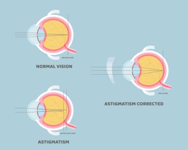 Göz bebeği anatomisi, iç organlar vücut parçası sinir sistemi, astigmatizm düzeltilmiş, görme konsepti, vektör çizimi düz tasarım klipsi sanatı