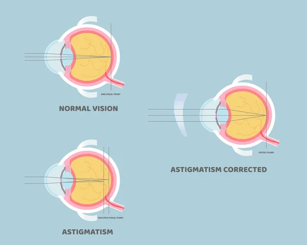 眼球解剖 内脏器官部分神经系统 散光矫正 视力概念 矢量插图漫画平面设计剪贴画 — 图库矢量图片