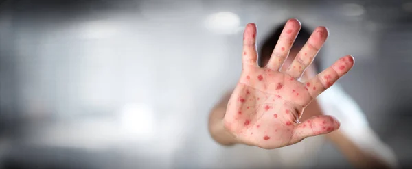 HFMD - Fièvre aphteuse des mains - Maladies virales à la main infectées — Photo