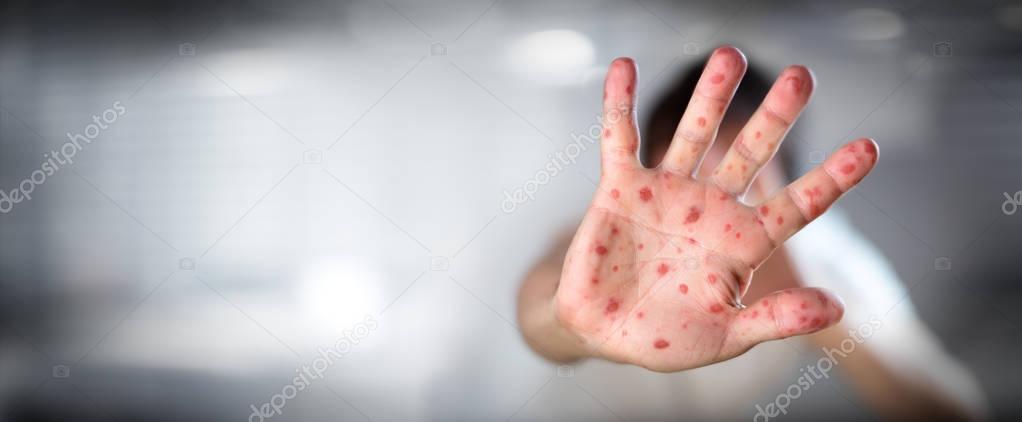 HFMD - Hand foot and mouth disease - Viral Diseases With Hand Infected