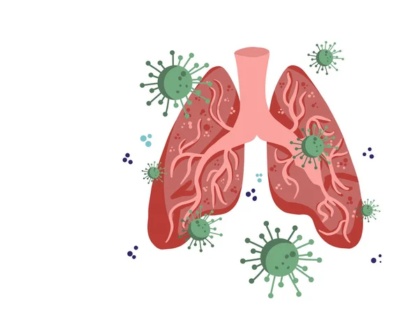 Covid Corona Virus 2019 Ncov Virus Affects Lung Damage Virus — Stock Vector