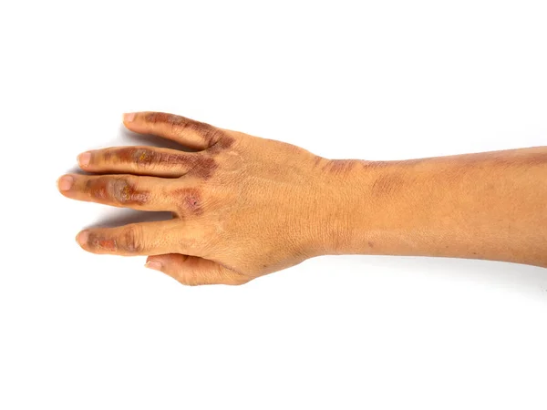 Beyaz arka planda yanmış orta yaşlı bir kadının eli. Kadın elinde korkunç yanıklar var.