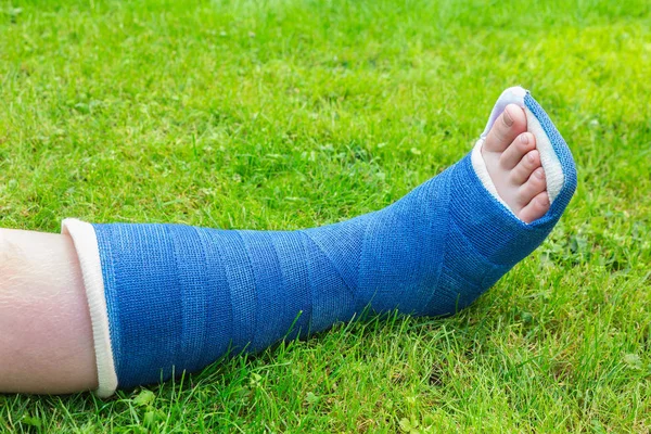 One gypsum leg of boy on grass — Stock Photo, Image