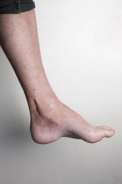 Ameliyat için Aşil tendonu, gelişen tendon iltihabı yaralanmalarda tedavi rüptürü.