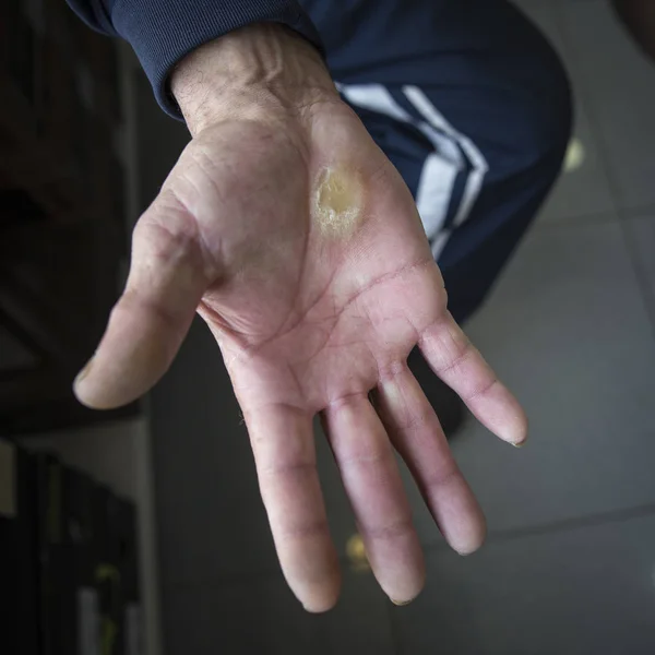 Verletzte Hände Schwielen Auf Krücken — Stockfoto