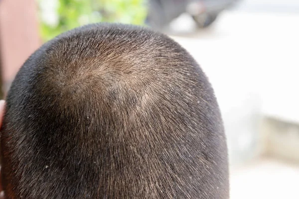Close-up skin head , scalp, photos of dermatitis and eczema, ski — Stock Photo, Image