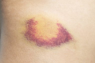 Closeup on a Bruise or hematoma on waist skin. clipart