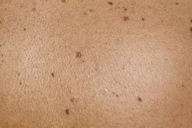 insan deri nevusta ile yakın çekim