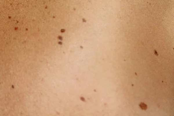 Close Human Skin Naevus — Stock Photo, Image